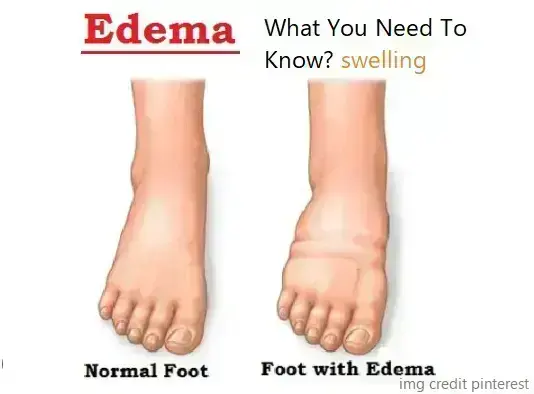 what-is-edema-with-types-causes-symptoms-and-treatment