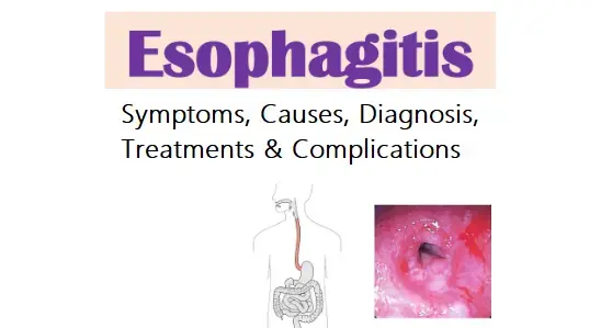 erosive-esophagitis-symptoms-causes-diagnosis-treatments-and-complications