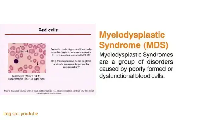 what-you-need-to-know-about-myelodysplastic-syndrome-or-mds
