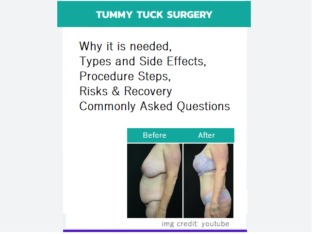 tummy-tuck-or-abdominoplasty-procedure-steps
