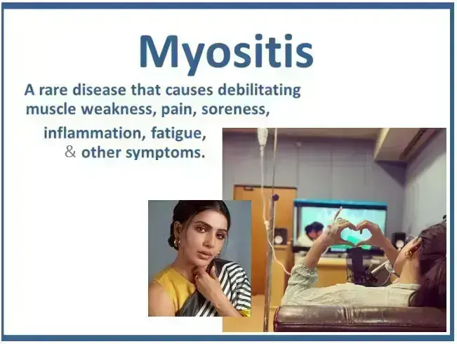 autoimmune-myositis:-understanding-bone-joint-and-muscle-disorders