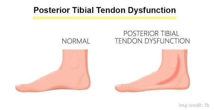 what-is-posterior-tibial-tendon-dysfunction-or-pttd