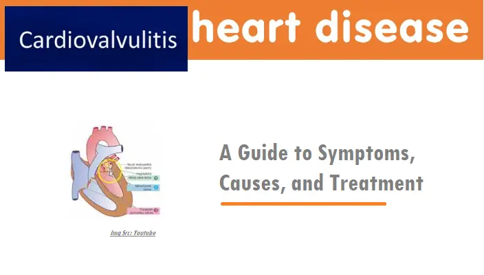 cardiovalvulitis:-a-guide-to-symptoms,-causes,-and-treatment