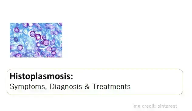 what-is-histoplasmosis