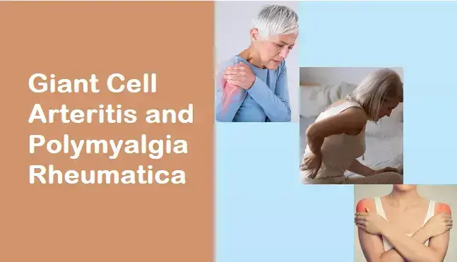 giant-cell-arteritis-and-polymyalgia-rheumatica:-unraveling-the-intricacies-of-two-complex-conditions