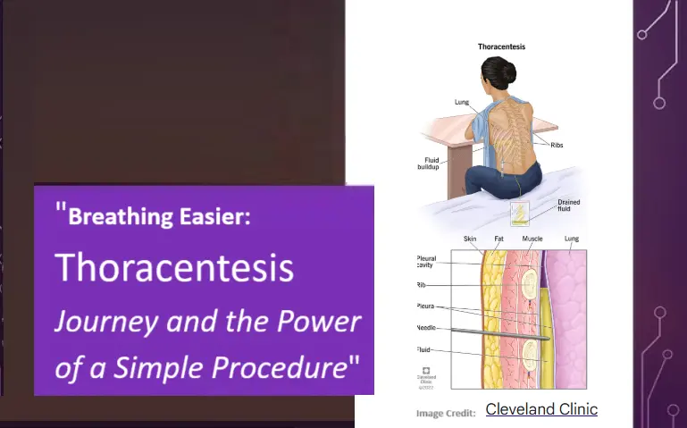 breathing-easier:-thoracentesis-journey-and-the-power-of-a-simple-procedure