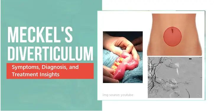 meckel-diverticulum-explained:-key-symptoms,-diagnosis,-and-treatment-insights