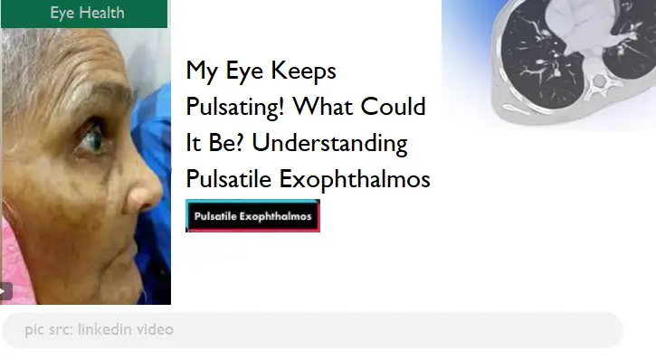 my-eye-keeps-pulsating!-what-could-it-be?-understanding-pulsatile-exophthalmos