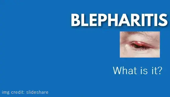 how-to-treat-blepharitis-eye-condition