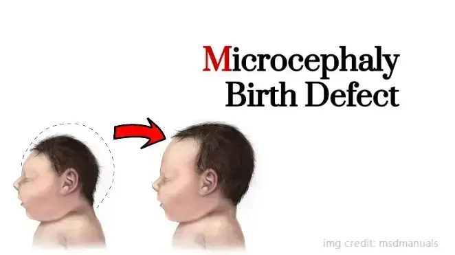 important-information-about-microcephaly