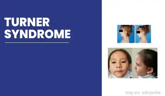 what-you-need-to-know-about-turner-syndrome