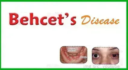 what-all-you-need-to-know-about-behçet-disease