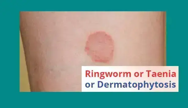 dermatophytosis-causes-treatment-and-distinctions-from-ringworm