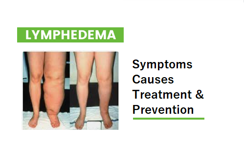know-about-lymphedema-with-symptoms-causes-treatment-and-prevention