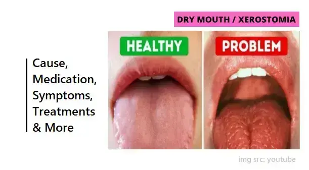how-to-diagnose-and-manage-dry-mouth-or-xerostomia