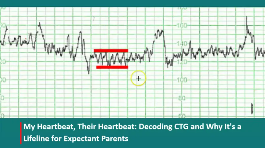my-heartbeat,-their-heartbeat:-decoding-ctg-and-why-it-is-a-lifeline-for-expectant-parents