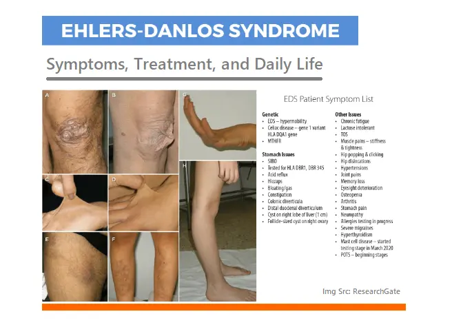 ehlers-danlos-syndrome:-symptoms,-treatment,-and-daily-life