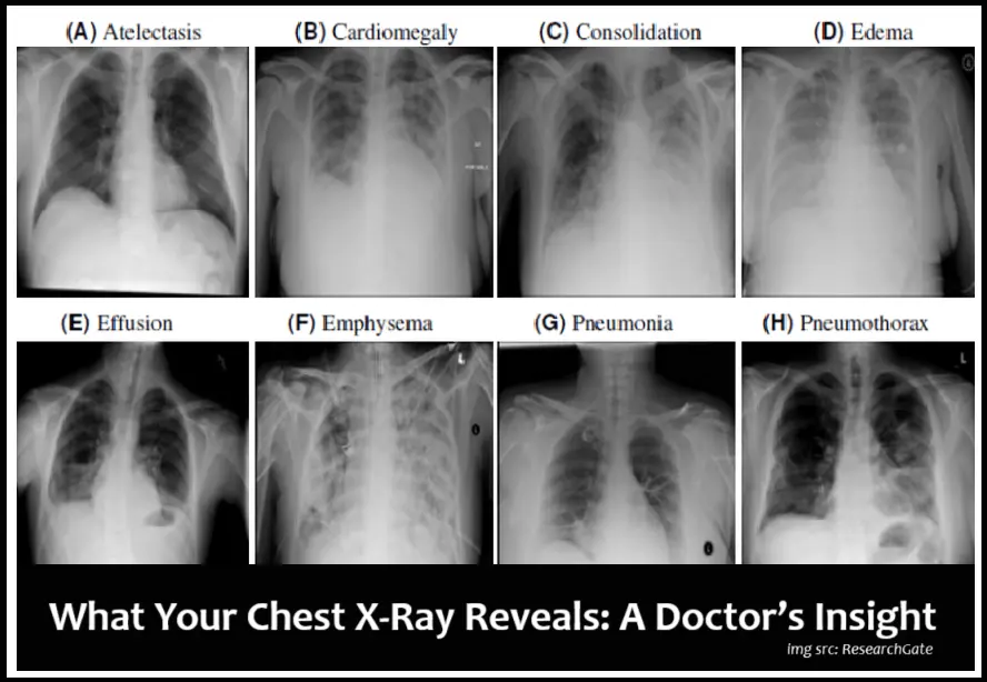 11-crucial-chest-x-ray-findings-doctors-look-for