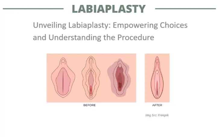 unveiling-labiaplasty:-empowering-choices-and-understanding-the-procedure