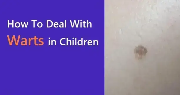 how-to-deal-with-warts-in-children
