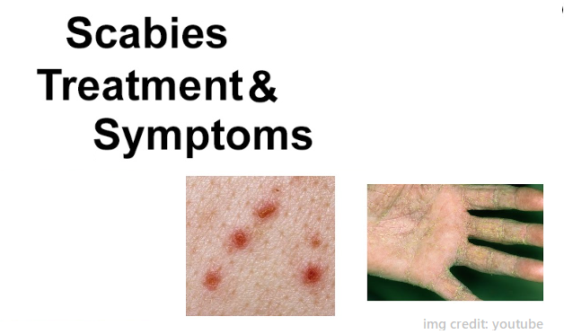 scabies-symptoms-diagnosis-and-treatment
