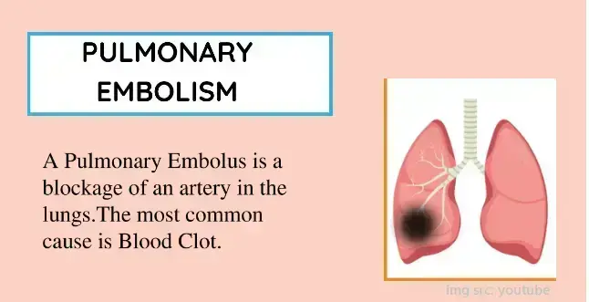 pulmonary-embolism-causes-warning-signs-and-risk-factors