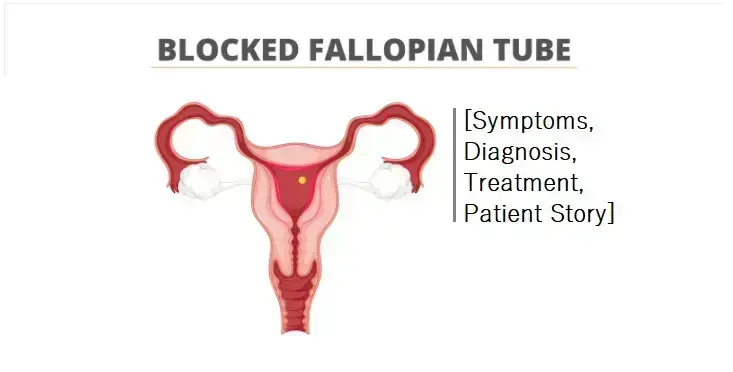 blocked-fallopian-tubes:-symptoms,-diagnosis,-treatment-and-success-story