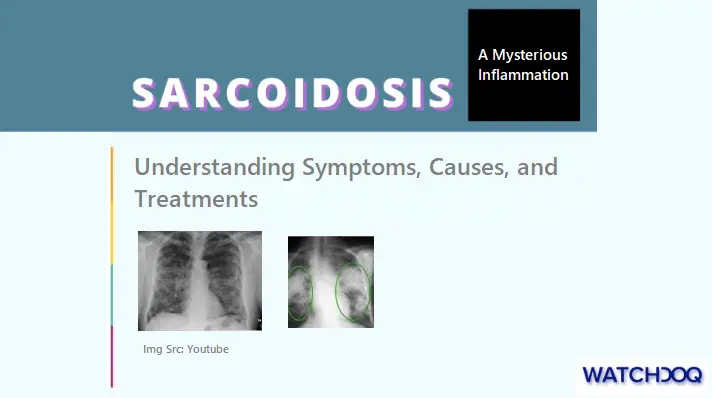 sarcoidosis-explained:-understanding-symptoms,-causes,-and-treatments