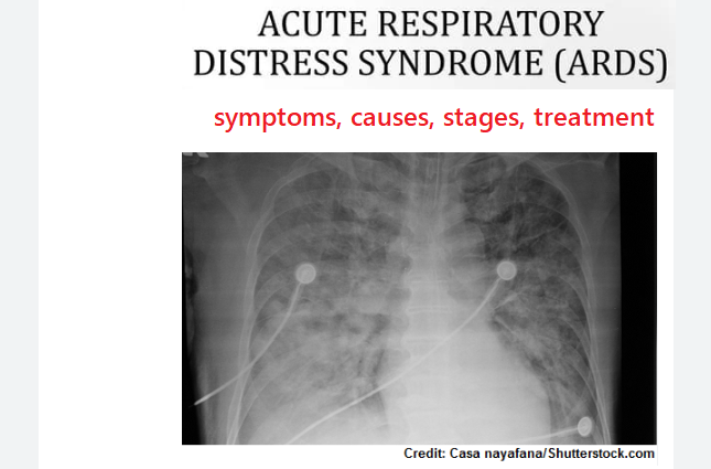 what-is-acute-respiratory-distress-syndrome